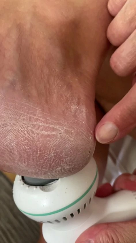 FootPedicure? - Eelt Verwijderaar Electrisch - Eeltvijl - Eelt Verwijderaar - Voetvijl 4 FootPedicure? - Eelt Verwijderaar Electrisch - Eeltvijl - Eelt Verwijderaar - Voetvijl - Image 2