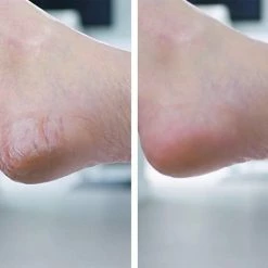 Mediashop PediVac Eeltverwijderaar - Elektrische Voet Vijl - Voetvijl - Veilig - Zuigfunctie - Voetverzorging - USB Oplaadbaar 17 Mediashop PediVac Eeltverwijderaar - Elektrische Voet Vijl - Voetvijl - Veilig - Zuigfunctie - Voetverzorging - USB Oplaadbaar -Lanaform Shop 550x465 6