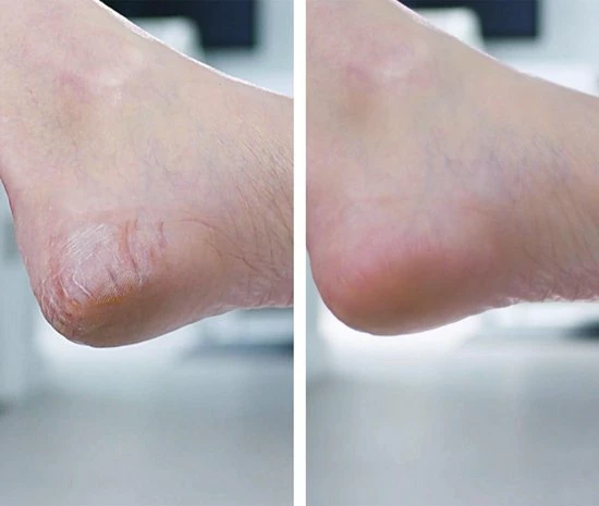 Mediashop PediVac Eeltverwijderaar - Elektrische Voet Vijl - Voetvijl - Veilig - Zuigfunctie - Voetverzorging - USB Oplaadbaar 6 Mediashop PediVac Eeltverwijderaar - Elektrische Voet Vijl - Voetvijl - Veilig - Zuigfunctie - Voetverzorging - USB Oplaadbaar - Image 4