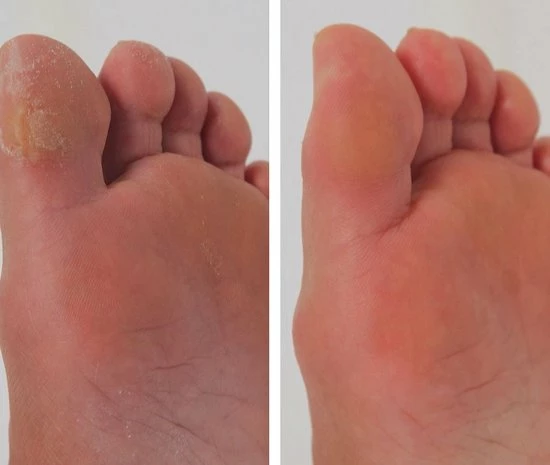 Mediashop PediVac Eeltverwijderaar - Elektrische Voet Vijl - Voetvijl - Veilig - Zuigfunctie - Voetverzorging - USB Oplaadbaar 7 Mediashop PediVac Eeltverwijderaar - Elektrische Voet Vijl - Voetvijl - Veilig - Zuigfunctie - Voetverzorging - USB Oplaadbaar - Image 5