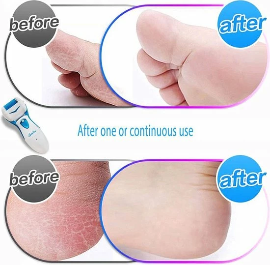 Krachtige Elektrische Voet Hard Skin Remover Oplaadbaar - # 1 Best Verkochte Eeltverwijderaar In De VS - HOMETEK-blauw 4 Krachtige Elektrische Voet Hard Skin Remover Oplaadbaar - # 1 Best Verkochte Eeltverwijderaar In De VS - HOMETEK-blauw - Image 2